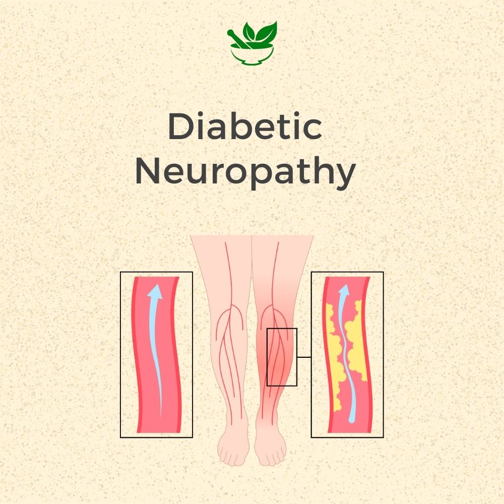 Diabetic Neuropathy Ayurvedic Management 30 Days Pack - Deep Ayurveda India