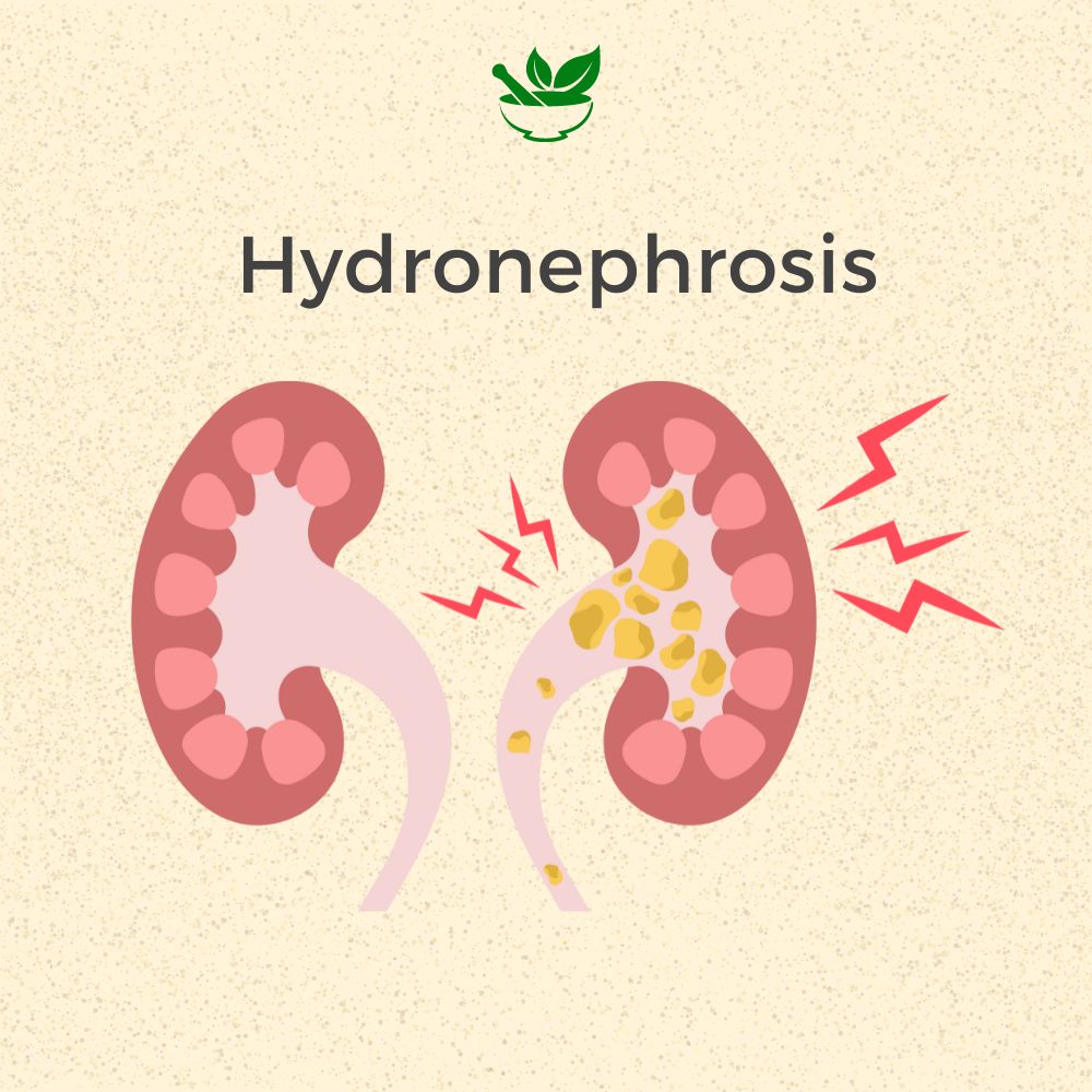 Hydronephrosis Ayurvedic Management 30 Days Pack - Deep Ayurveda India