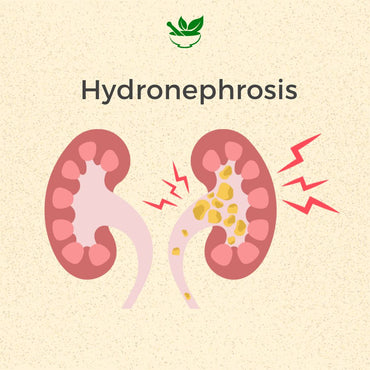 Hydronephrosis Ayurvedic Management 30 Days Pack - Deep Ayurveda India