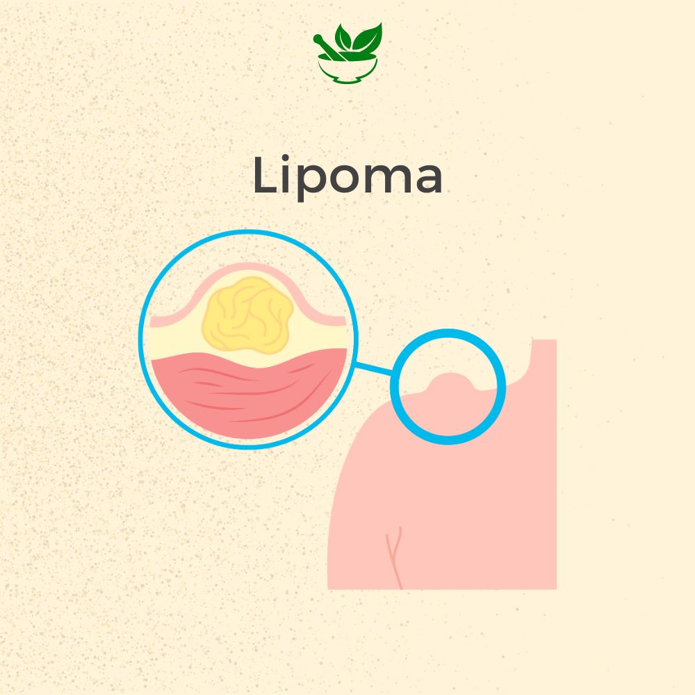 Lipoma Ayurvedic Management 30 Days Pack - Deep Ayurveda India