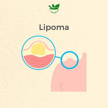 Lipoma Ayurvedic Management 30 Days Pack - Deep Ayurveda India